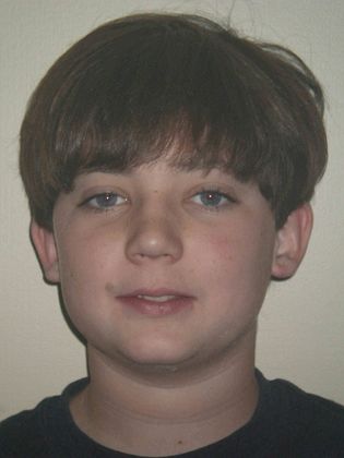 Orthodontic treatment in Phases: Case 4 - Before