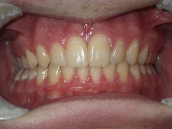 Orthodontic treatment in Phases: Case 4 - After
