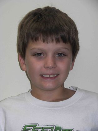 Orthodontic treatment in Phases: Case 5 - Before