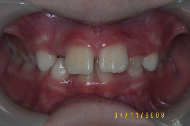 Orthodontic treatment in Phases: Case 5 - Before