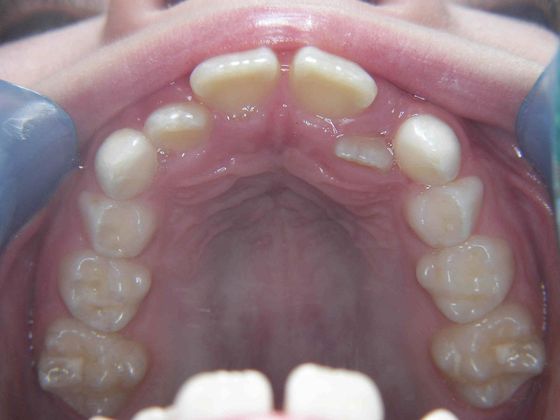 Orthodontic treatment in Phases: Case 5 - Before