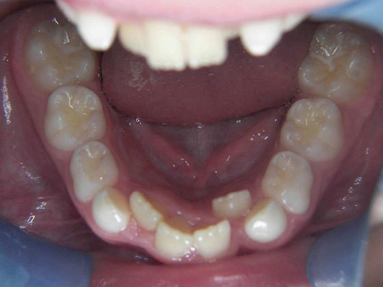 Orthodontic treatment in Phases: Case 5 - Before