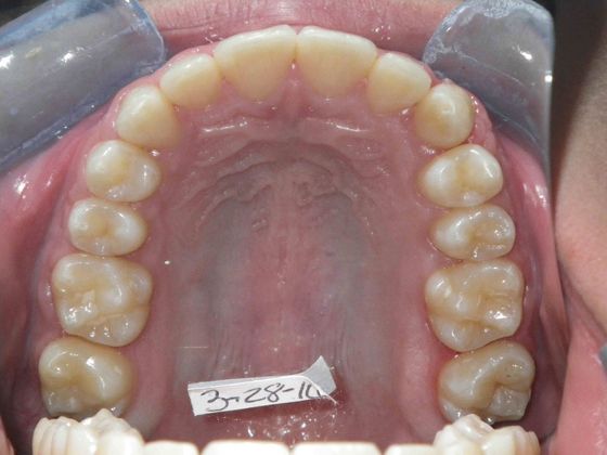 Orthodontic treatment in Phases: Case 5 - After