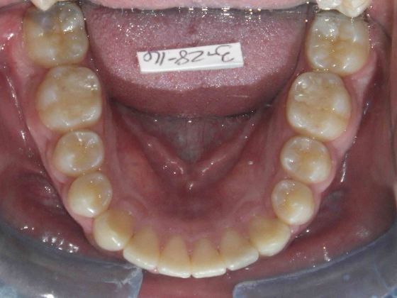 Orthodontic treatment in Phases: Case 5 - After