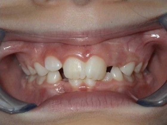 Orthodontic treatment in Phases Case 6 - Before