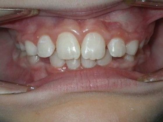 Orthodontic treatment in Phases Case 6 - After