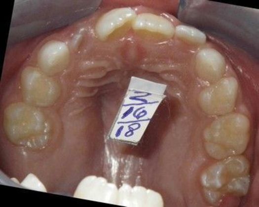 Orthodontic treatment in Phases: Case 6 - After
