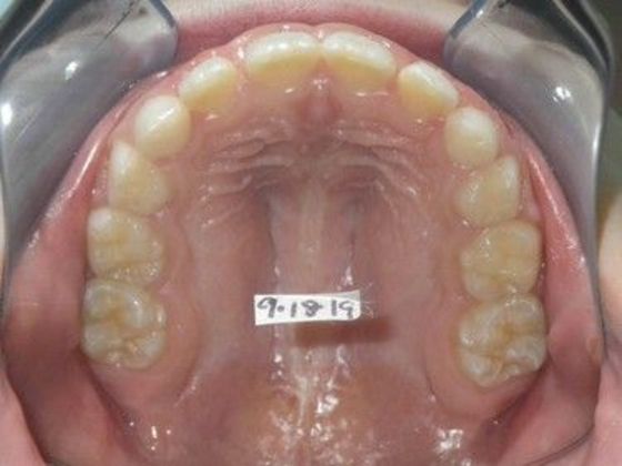 Orthodontic treatment in Phases: Case 6 - Before