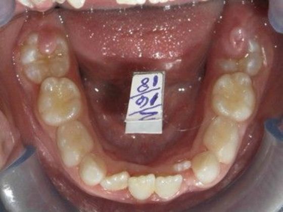 Orthodontic treatment in Phases: Case 6 - Before