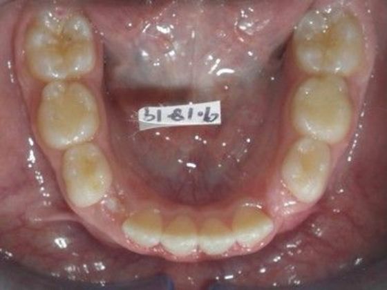 Orthodontic treatment in Phases: Case 6 - After