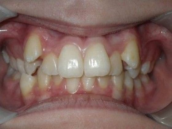 Orthodontics Case 17 - Before