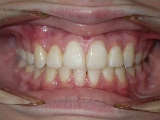 Orthodontics Case 17 - After