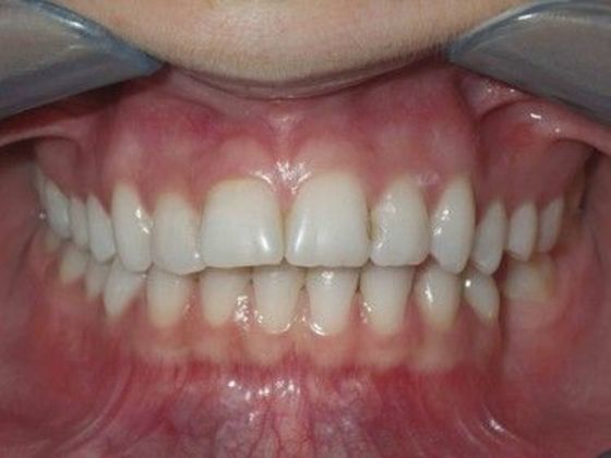 Orthodontics Case 18 - Before