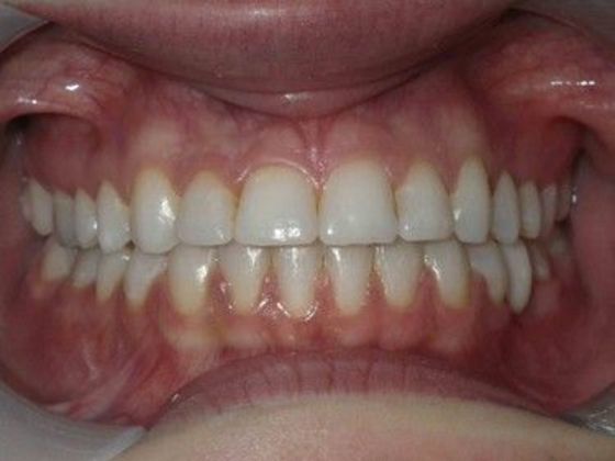 Orthodontics Case 18 - After