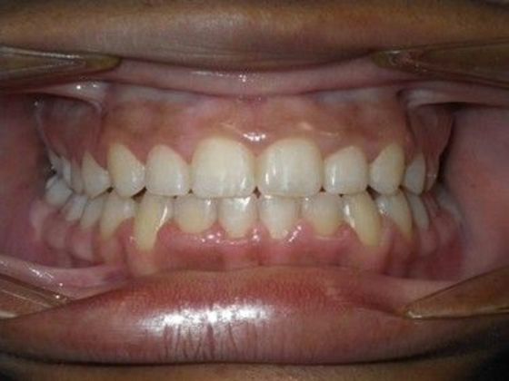 Orthodontics Case 19 - After