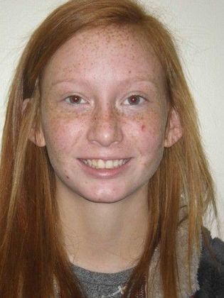 Orthodontics: Case 20 - Before