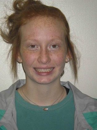 Orthodontics: Case 20 - After