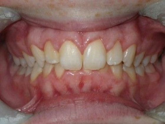 Orthodontics Case 20 - Before