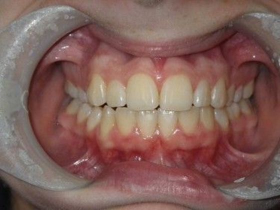 Orthodontics Case 21 - Before