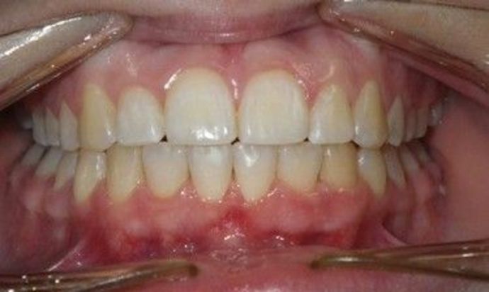 Orthodontics Case 21 - After