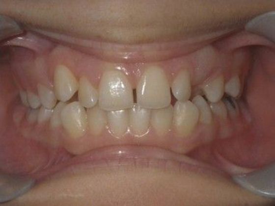 Orthodontics Case 22 - Before