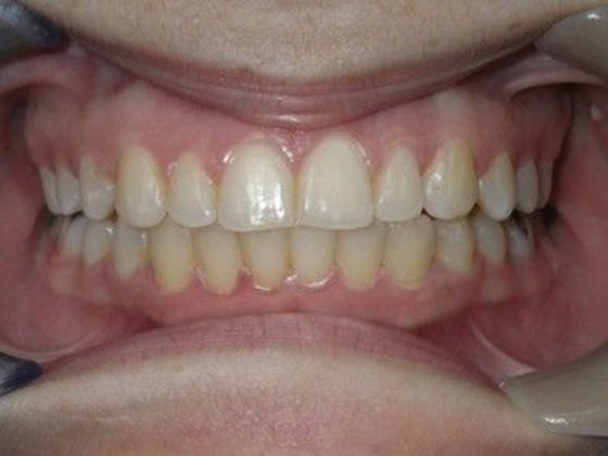 Orthodontics Case 22 - After