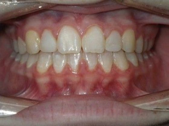 Orthodontics Case 23 - After
