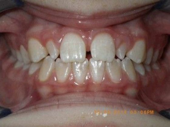 Orthodontics Case 23 - Before
