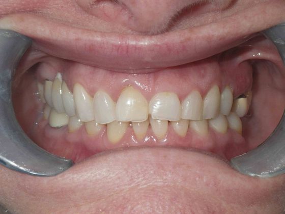 Full Mouth Reconstruction Case 1 - Before