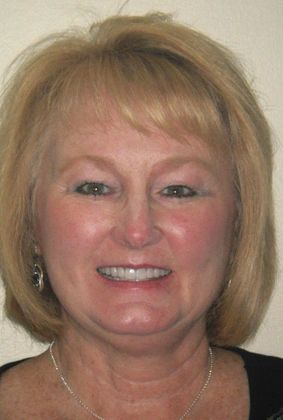 Full Mouth Reconstruction: Case 1 - After