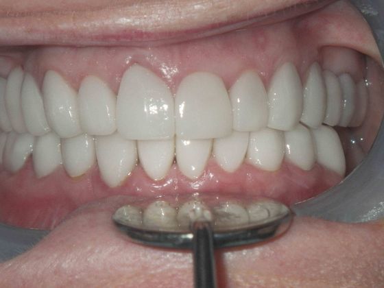 Full Mouth Reconstruction Case 1 - After