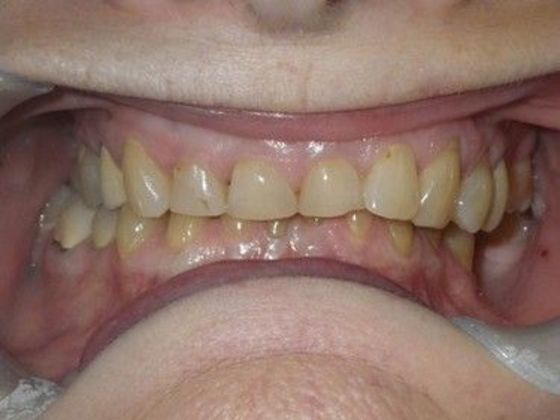 Full Mouth Reconstruction Case 2 - Before