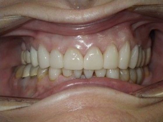 Full Mouth Reconstruction Case 2 - After