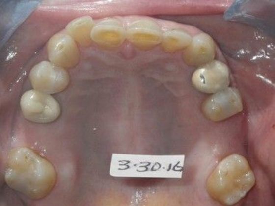 Full Mouth Reconstruction: Case 2 - Before