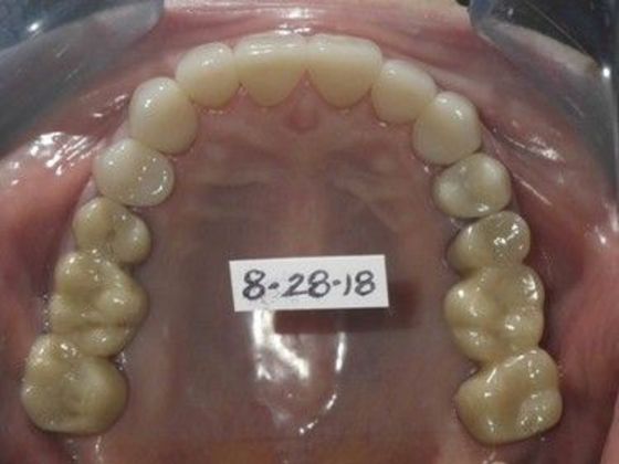 Full Mouth Reconstruction: Case 2 - After