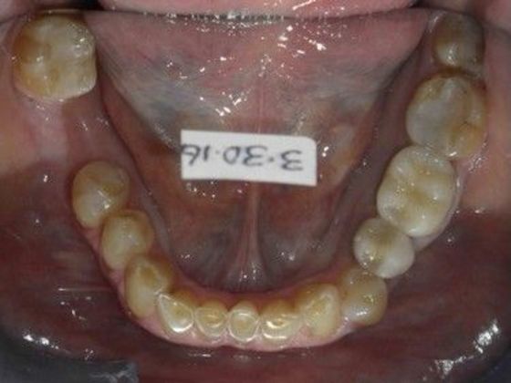 Full Mouth Reconstruction: Case 2 - Before