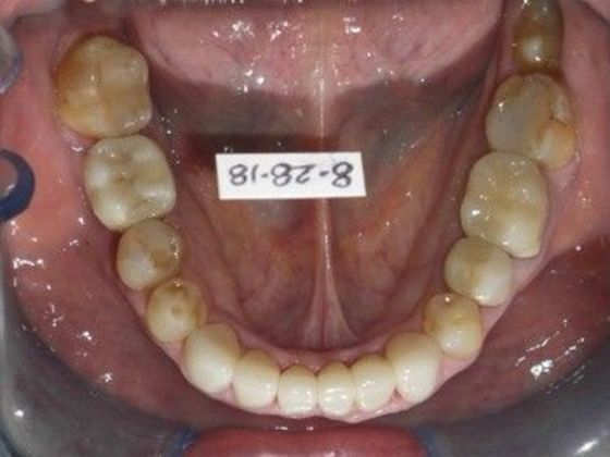 Full Mouth Reconstruction: Case 2 - After