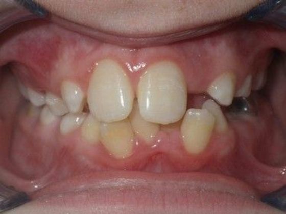 Orthodontic treatment in Phases: Case 7 - Before