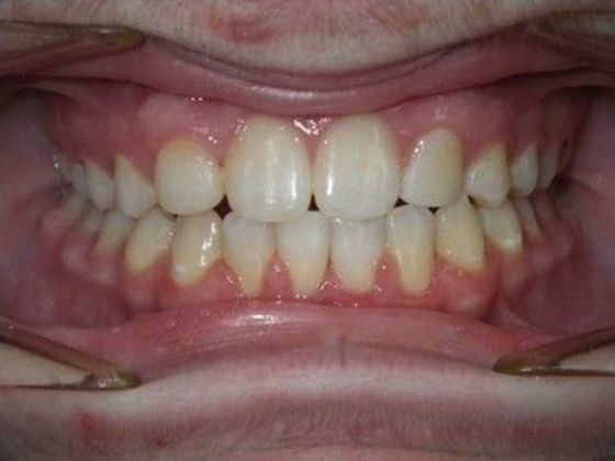 Orthodontic treatment in Phases: Case 7 - After