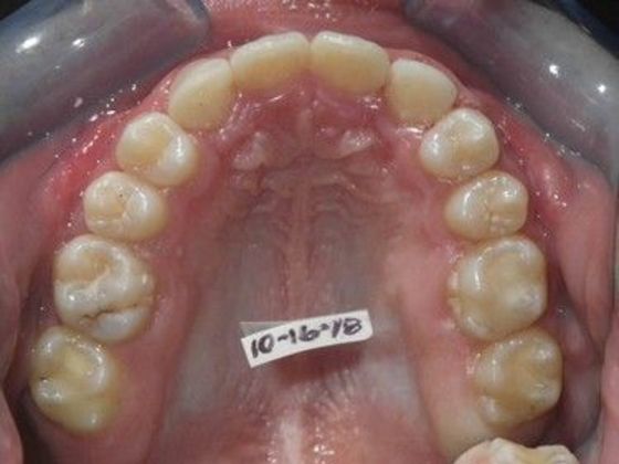 Orthodontic treatment in Phases: Case 7 - After