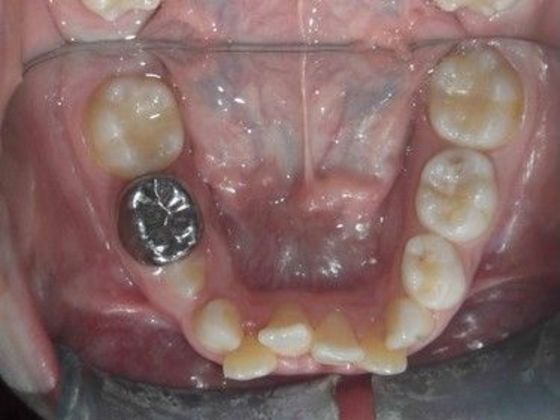Orthodontic treatment in Phases: Case 7 - Before