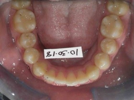 Orthodontic treatment in Phases: Case 7 - After