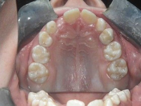 Orthodontic treatment in Phases: Case 7 - Before