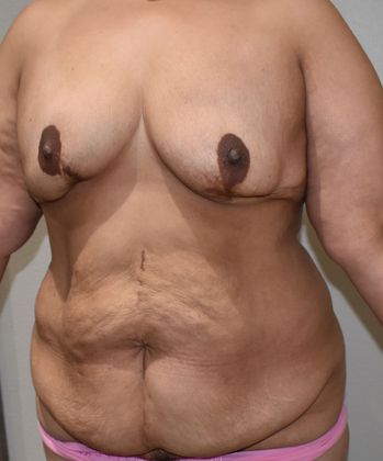 Massive Weight Loss : Case 70 - Before