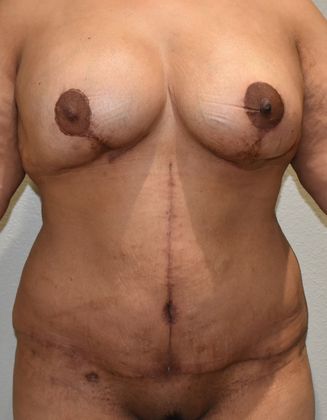 Mommy Makeover Case 156 - After