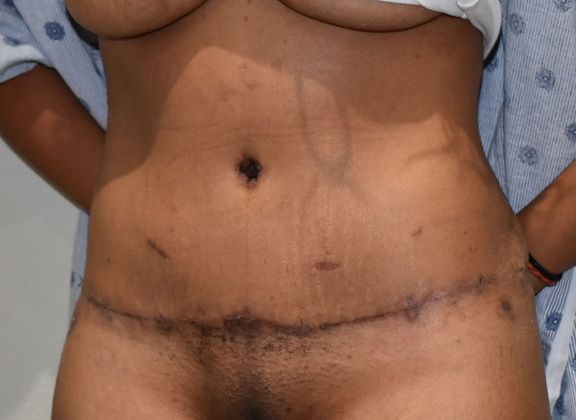 Tummy Tuck (Abdominoplasty): Case 231 - After