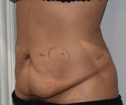 Tummy Tuck (Abdominoplasty): Case 231 - Before