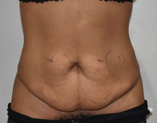 Tummy Tuck (Abdominoplasty): Case 231 - After