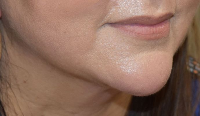 BodyTite Case 3 - After