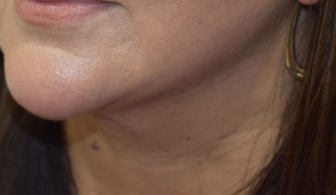 BodyTite: Case 3 - After